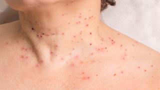 Ето как ефективно да премахнете папиломите по кожата