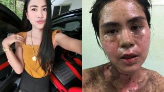 Момиче взе ибупрофен заради зъбобол и стана страшно СНИМКИ 18+