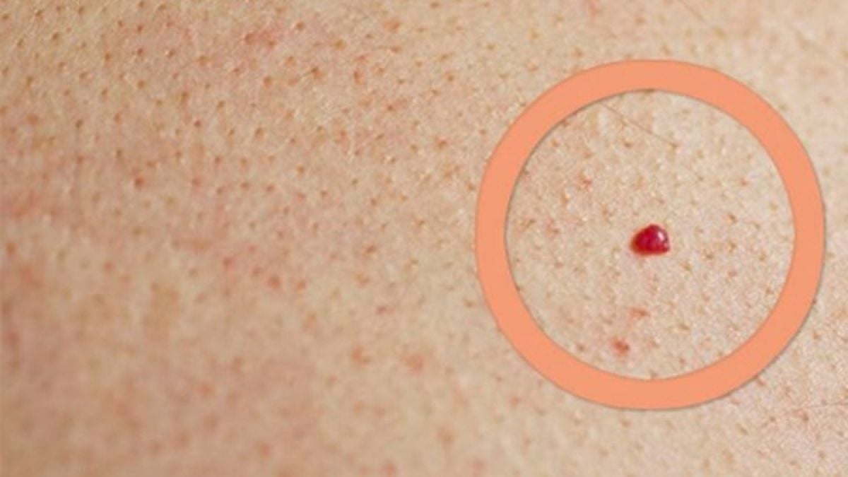  Опасни ли са червените бенки и трябва ли да посетите лекар