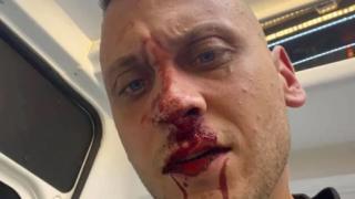 Пребитият лидер на контрапротестите пред БЛИЦ: Знам кой ме поръча! Отровното трио насади агресия срещу мен