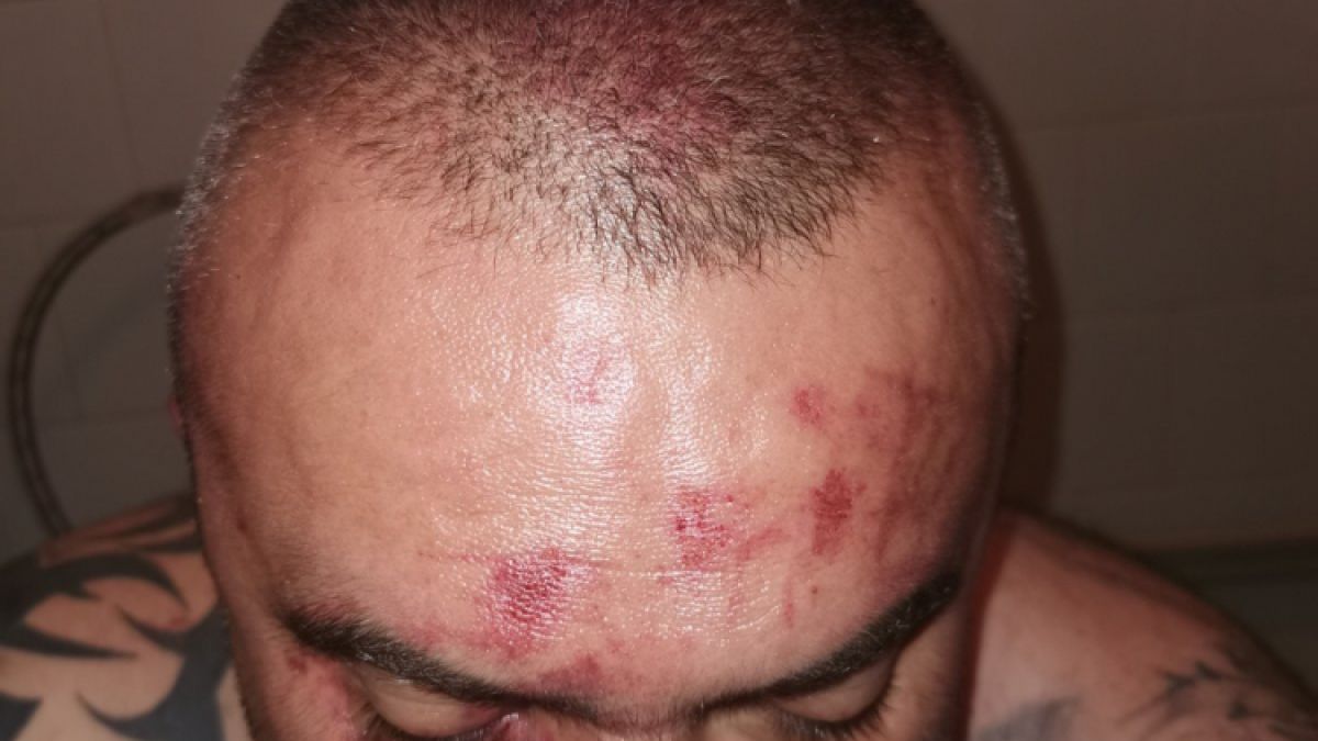Зловещи подробности за Ради Дългия, пребит брутално от общинар на Марешки ВИДЕО 18+