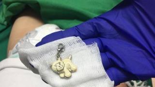 Пазарджишки лекари разрязаха гърлото на 2-г. дете и извадиха нещо шокиращо СНИМКА 18+
