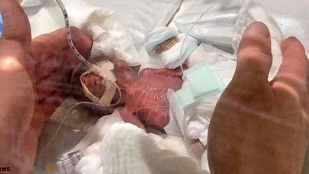 В Япония се роди най-малкото бебе – само 268 грама. И вече е изписано!