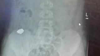 Майка заведе сина си на лекар и онемя от това, което видя на рентгена СНИМКИ