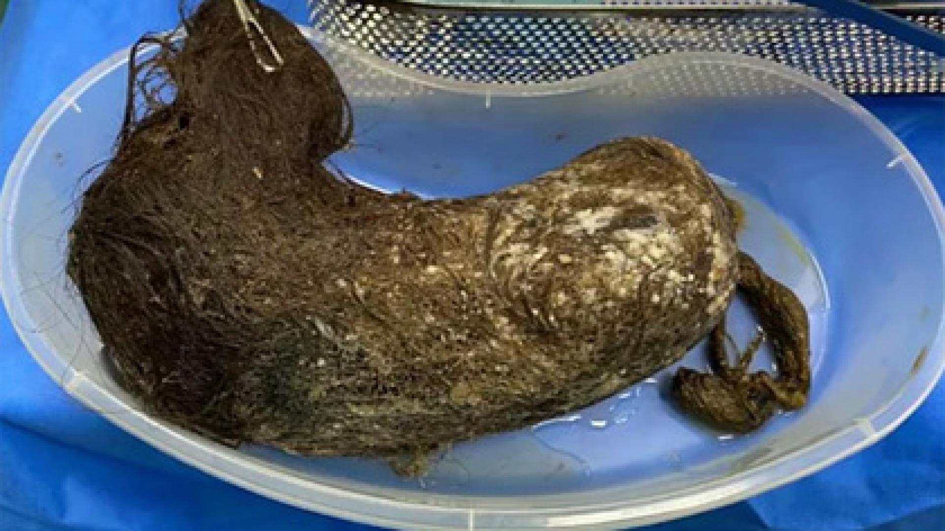 Ужасяващо! Огромна топка коса разкъса стомаха на момиче СНИМКА