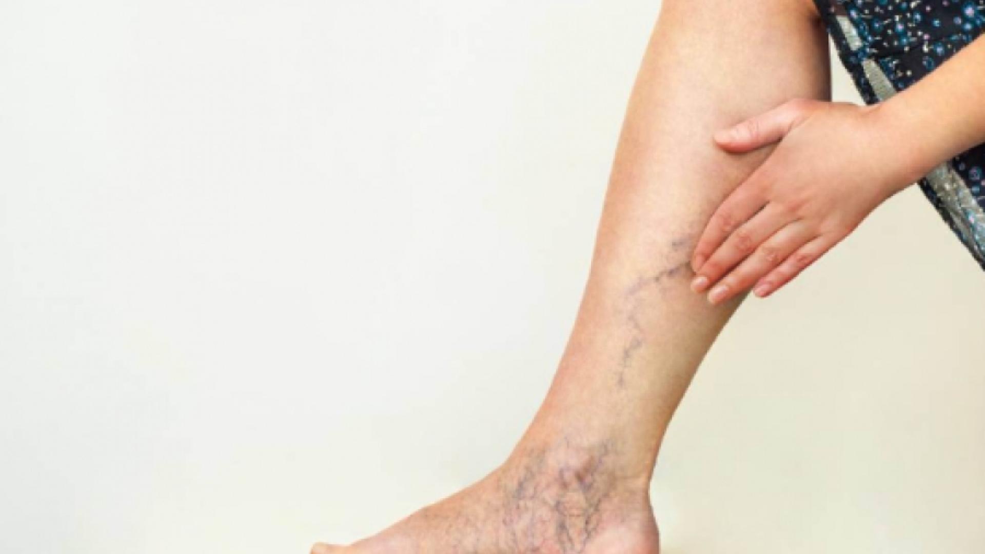 Не лекувайте така разширени вени, опасно е