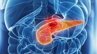 Симптомите на най-агресивния вид рак посочиха US-учени