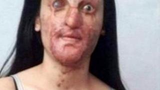 Момиче се омъжи за изверга, който обезобрази лицето й, заливайки го с киселина СНИМКИ 