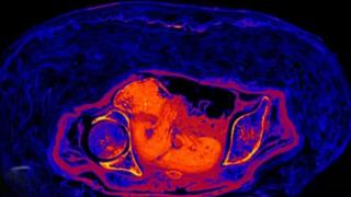 Разгадана е мистерията на нероденото бебе  в египетска мумия