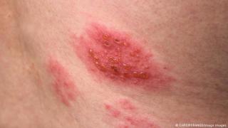 Изследване установи случаи на херпес зостер след ваксинация с Pfizer. Защо?