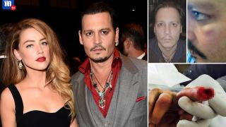 Сагата става кървава: Амбър Хърд издрала лицето на Джони Деп, показаха негови СНИМКИ със синини