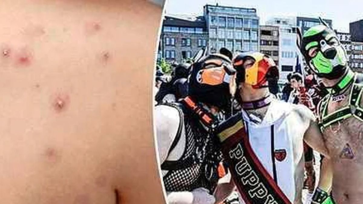Висш съветник от СЗО: Големи партита на хомосексуалисти донесоха маймунската шарка в Европа