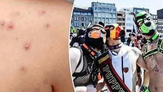 Висш съветник от СЗО: Големи партита на хомосексуалисти донесоха маймунската шарка в Европа