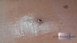 Не е за вярване каква гнусотия излезе от обикновена черна точка ВИДЕО