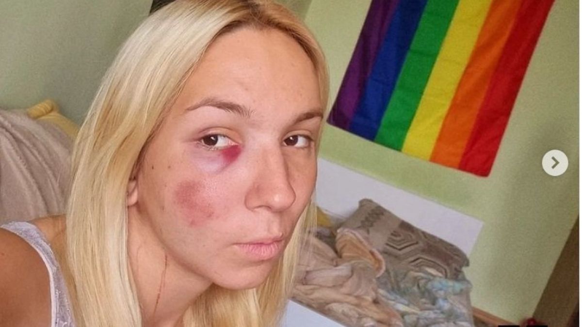 Дрогираната Емили с тротинетката пусна страшна СНИМКА 18+ след като я помля бус