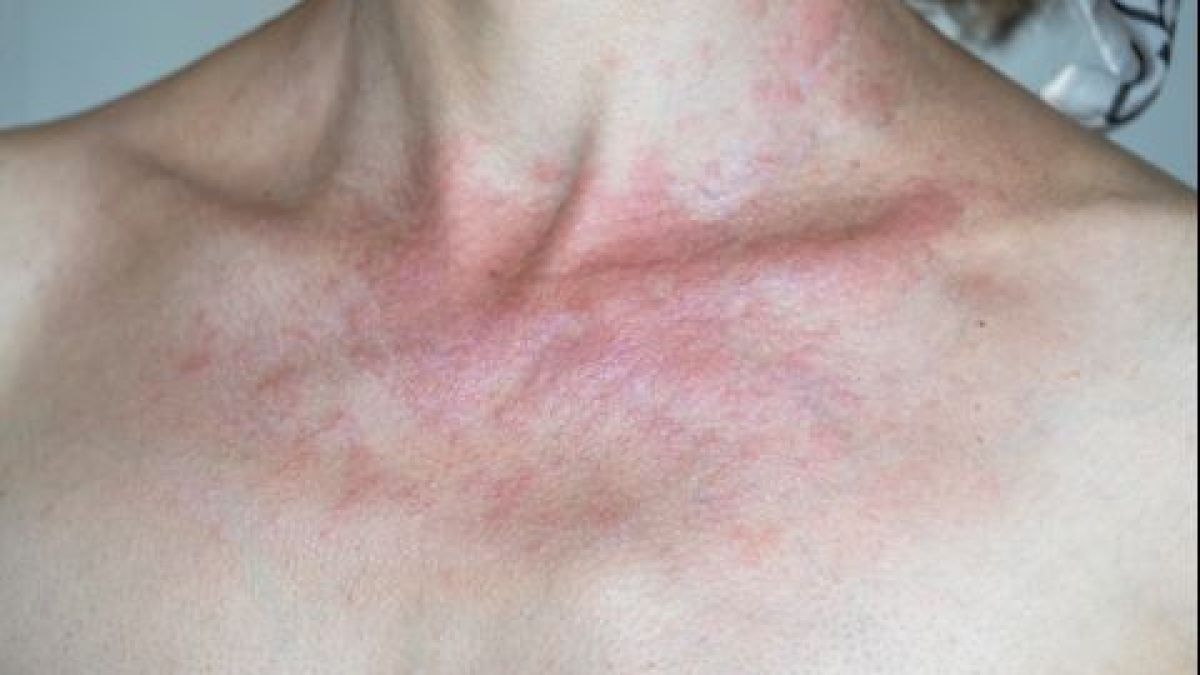 Пет признака, че сте алергични към храна, която сте яли наскоро