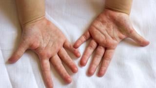 Тези състояния на ръцете ви издават имате ли проблем с черния дроб!