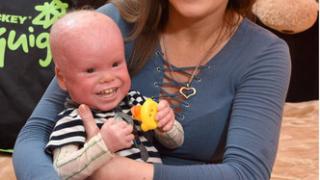 Бременността на Анна бе нормална, но роди чудовище, а после... СНИМКИ