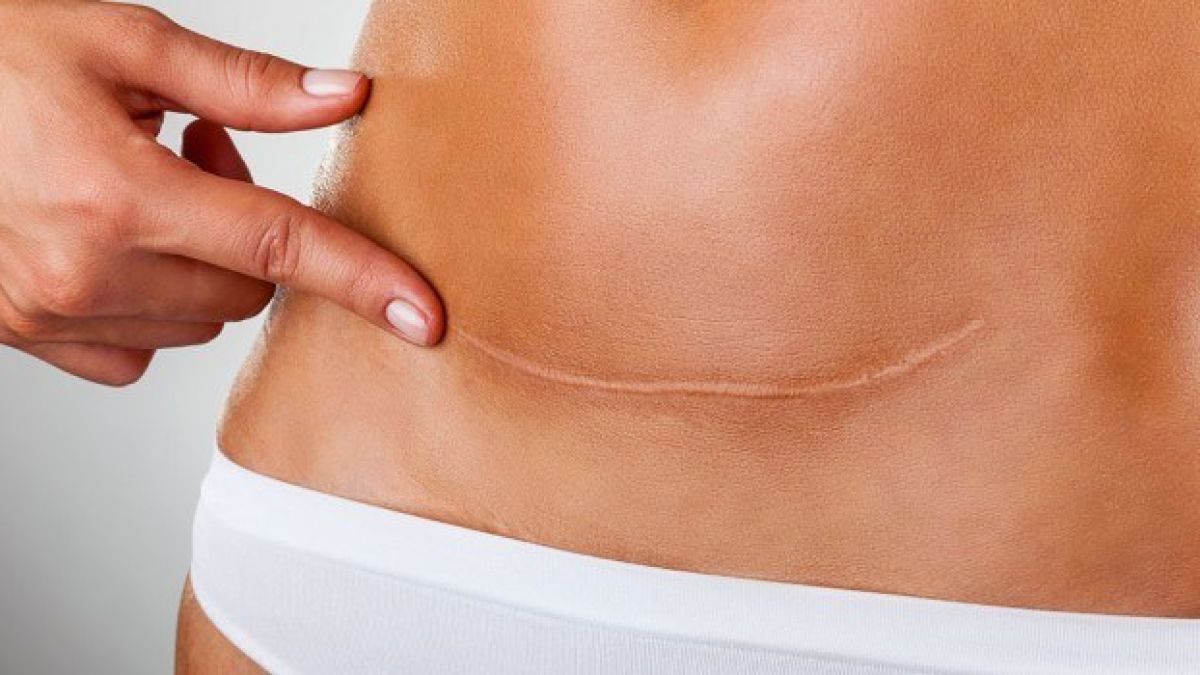 Експерти посочиха единствените лекарства, които заличават белези