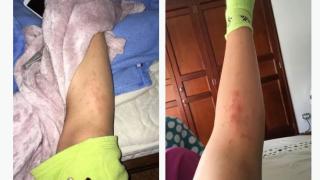 Това не е обрив, а яйца на паразити, имате ли го – тичайте при лекар