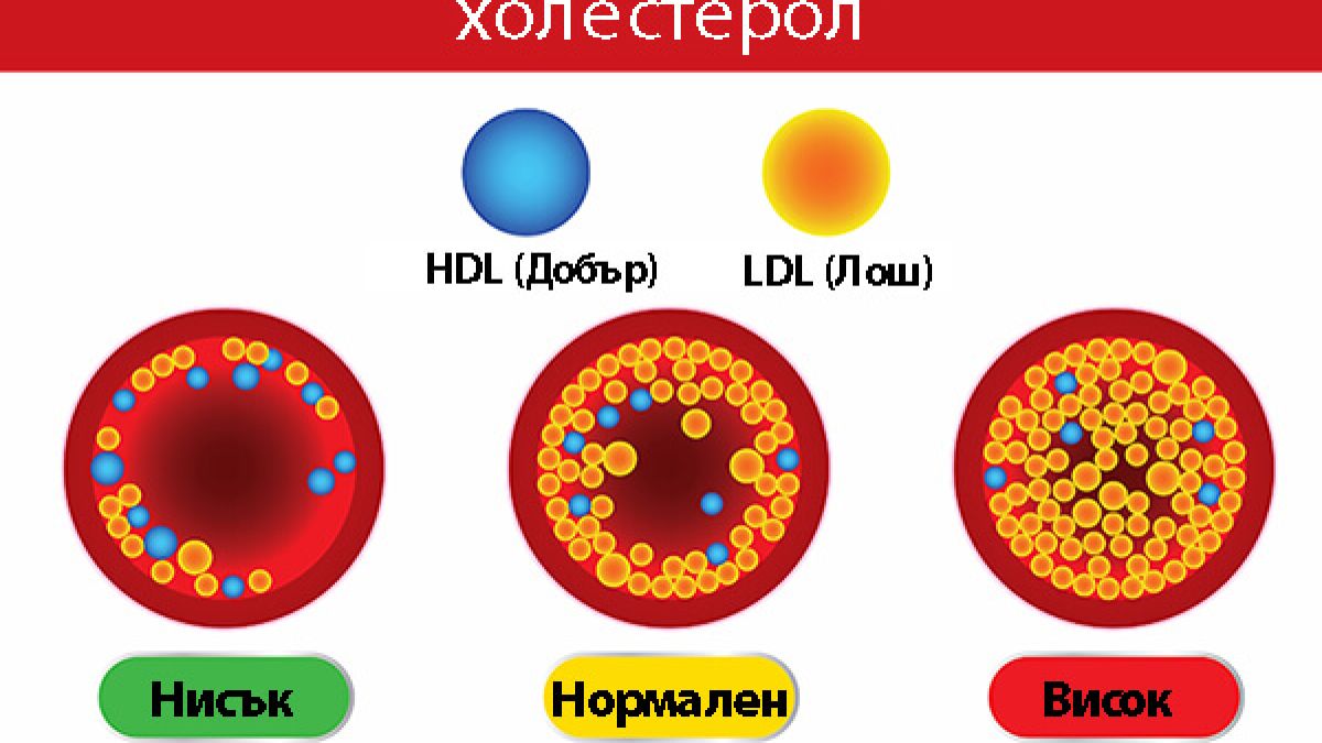 Внимание: Този симптом говори за опасни нива на холестерола