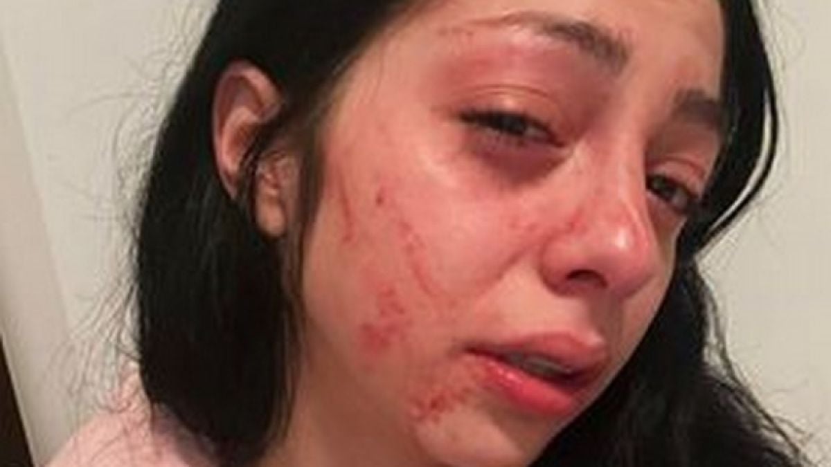 Потресаващо: Появи се кървава СНИМКА 18+ на битото от прокурорския син Васил момиче