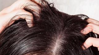 Смесих тези 2 съставки и се сбогувах с пърхота завинаги