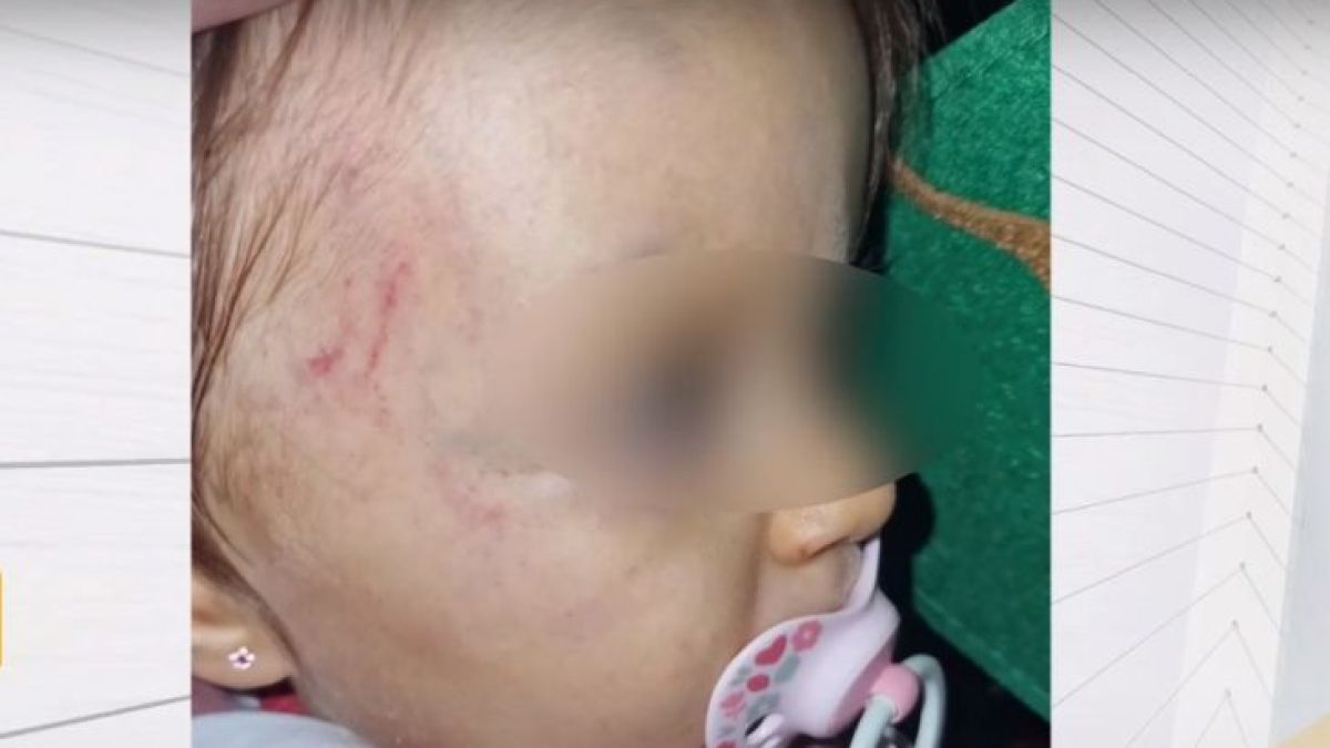Скандално: Детски център върна 1-г. дете с кръвоизливи и синини по главата на майката ВИДЕО