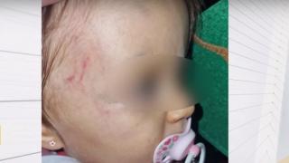 Скандално: Детски център върна 1-г. дете с кръвоизливи и синини по главата на майката ВИДЕО