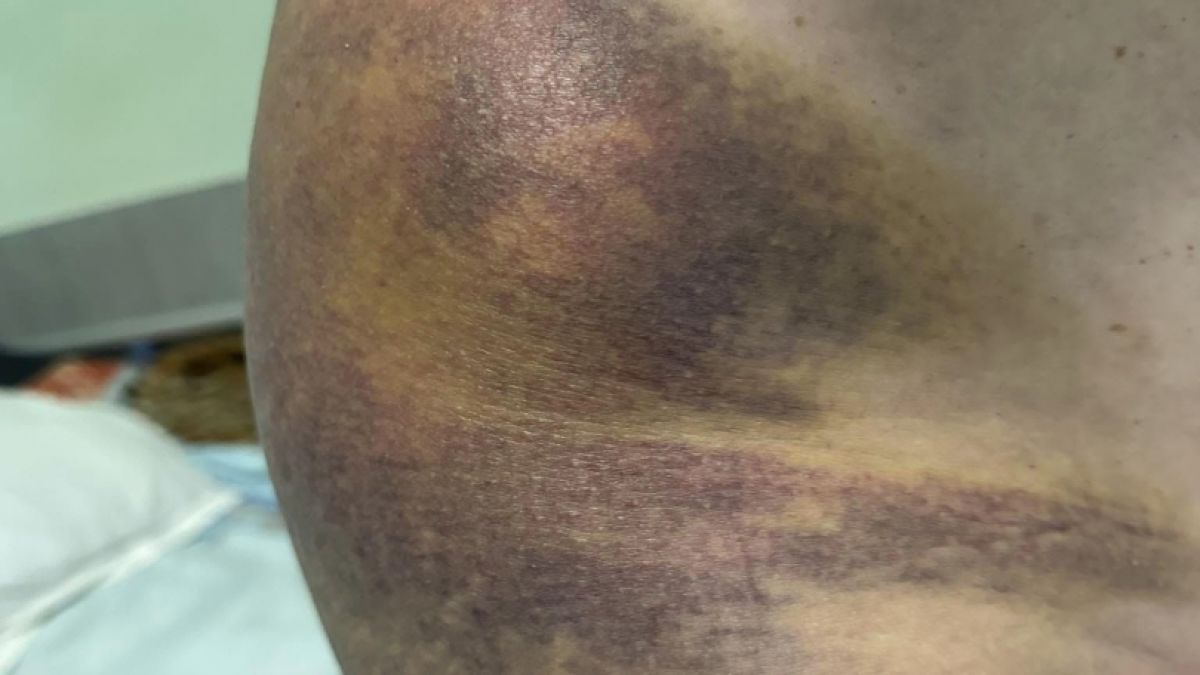 Тъщата на спипания на калъп кмет на Цалапица показа СТРАШНИ СНИМКИ 18+ 