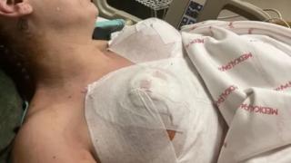 Жена си сложи силиконови гърди в Турция, след дни потече зелена гной и... СНИМКА 18+