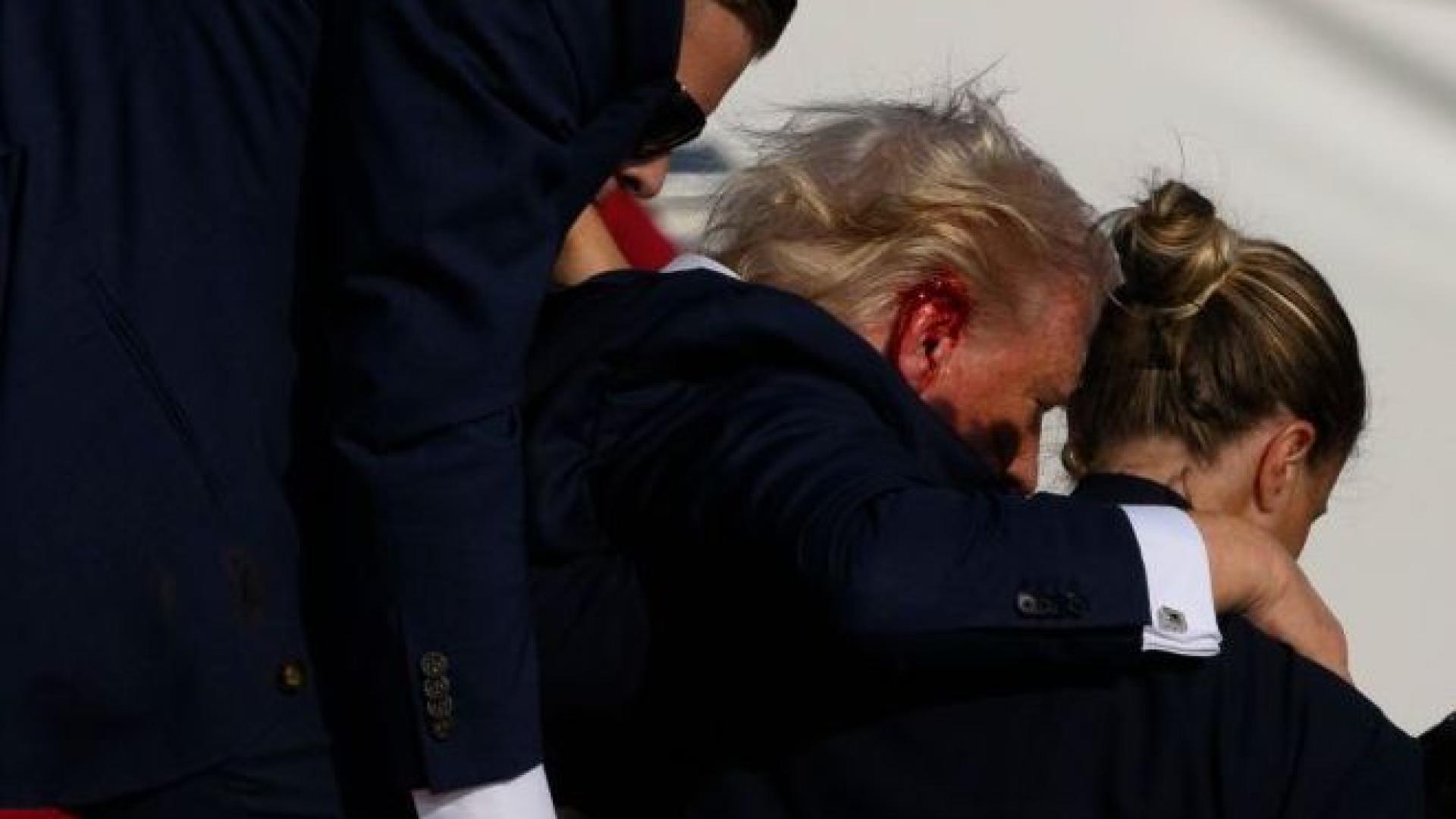 Пластичен хирург разкри тежките последици за Тръмп, ликът му никога няма да е същият