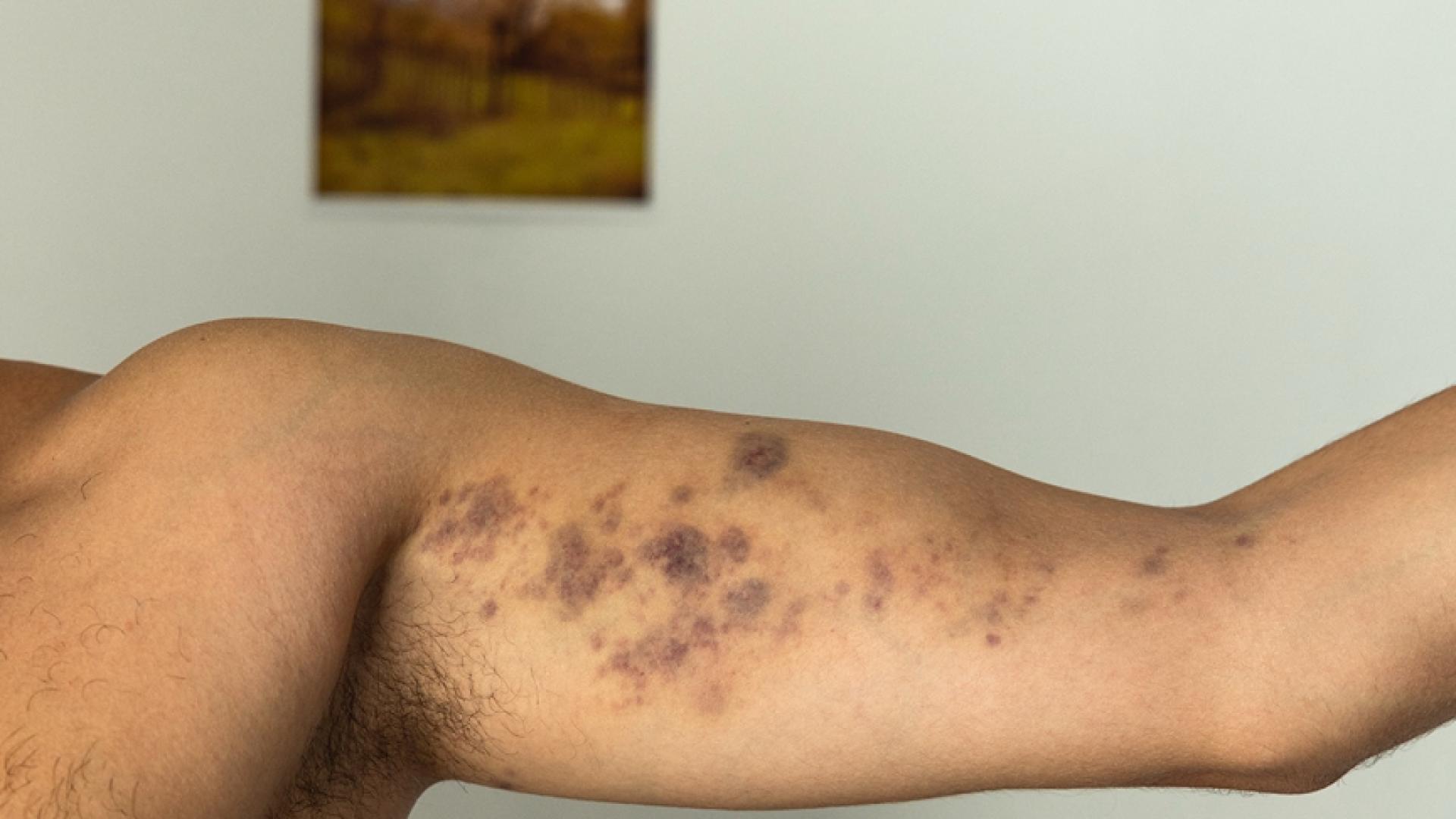 Див екшън в Пловдив: Охранители потрошиха от бой певец, счупиха му зъбите СНИМКИ 18+