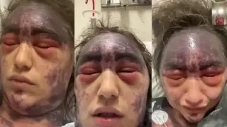 Внимавайте: Красавица си сложи ваксина, а после лицето й посиня и ослепя ВИДЕО 18+