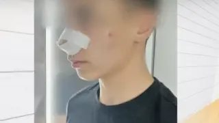 „Помня само един удар“: Смязаха от бой 13-г. ученик в Русе