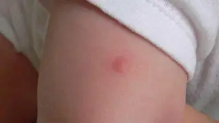 Шок: Жена загуби 16 пръста след мистериозно ухапване 
