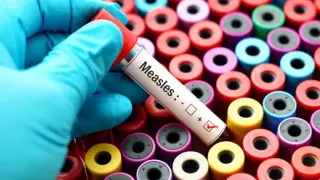 Над 1000 случая на морбили в Румъния за месец