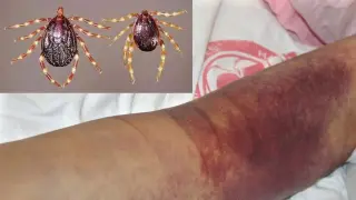 Треската Кримска-Конго сее смърт в Турция, жертвите вече са 18