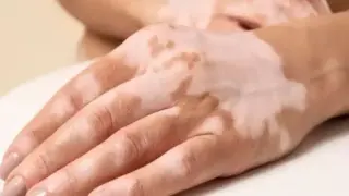 При витилиго следвайте тези рецепти и няма да сбъркате