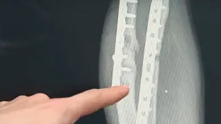 Уникална операция: Наши лекари спасиха ръката на 17-г. момче видео