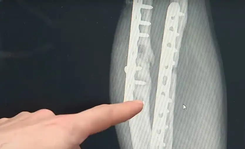 Уникална операция: Наши лекари спасиха ръката на 17-г. момче видео