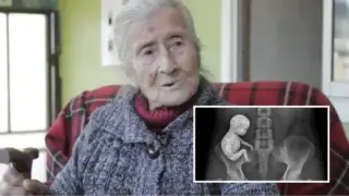 Историята на вкамененото бебе: Възрастна жена разбира, че е била бременна 60 г. по-късно