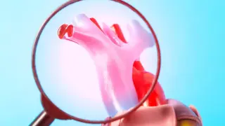 Болестта, която не боли навреме: Защо атеросклерозата е толкова опасна