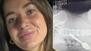 Млада жена глътна 17 см лъжица докато хапва Снимки
