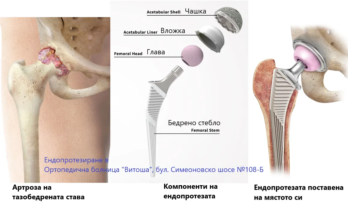 Нов метод за безкръвно ендопротезиране спаси жена, тежаща 160 кг