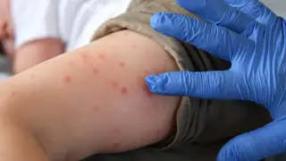 Нови случаи на морбили в Плевен и Враца, болниците се запълват