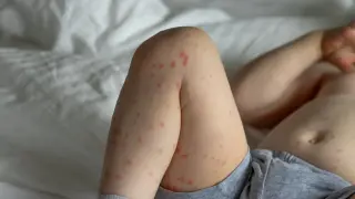 Епидемия уби стотици деца за 2 месеца, 50 000 са били повалени