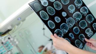Магнитна стимулация образува паметови клетки при Алцхаймер 