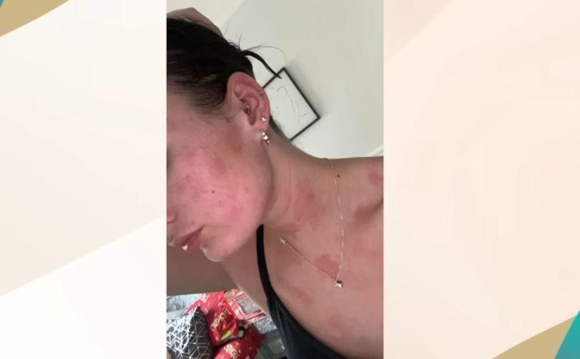 Водата я разболява: 24-г. Ерин не може да се поти, къпе или плува Видео