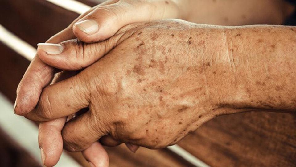 Старческите петна са безобиден недостатък
